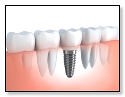 dental implant image